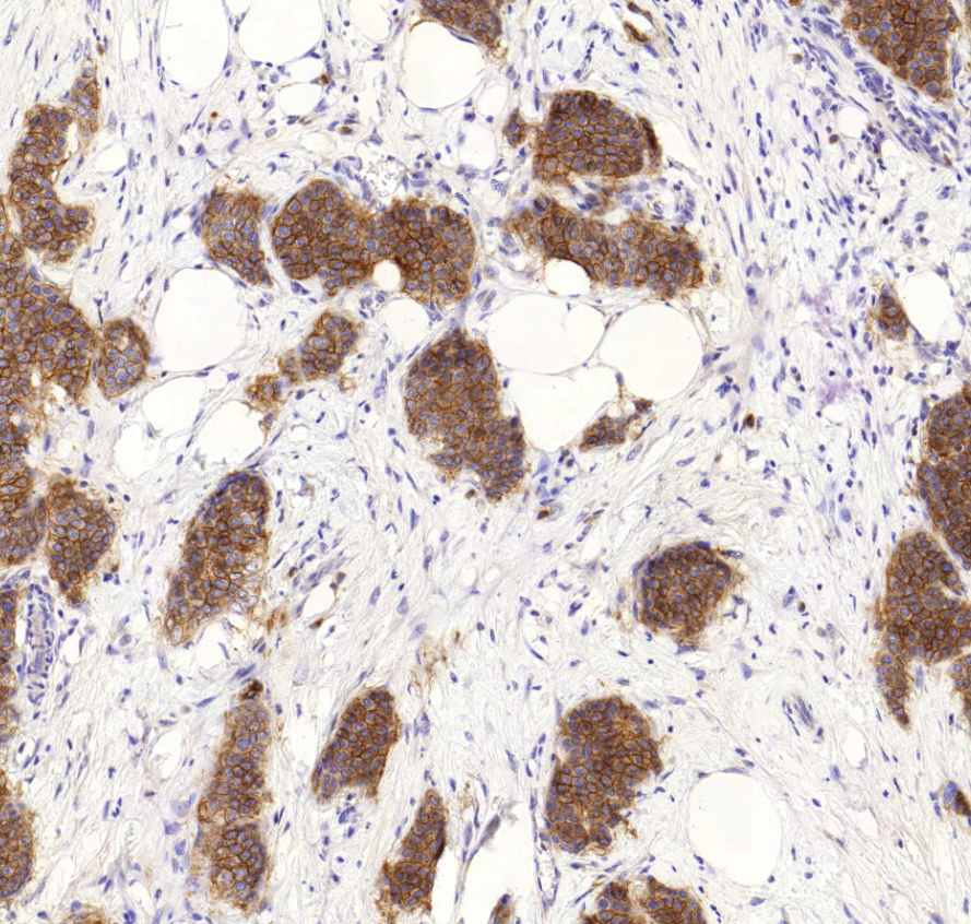 carcinoma ductale invasivum mammae (Her-2)