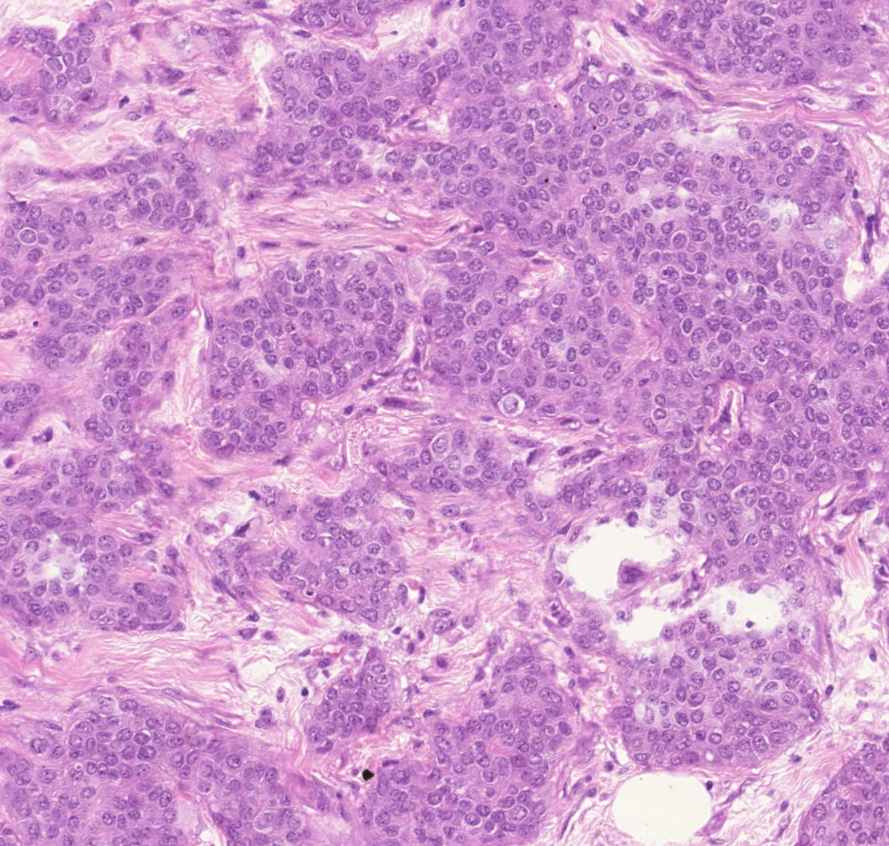 carcinoma ductale invasivum mammae0