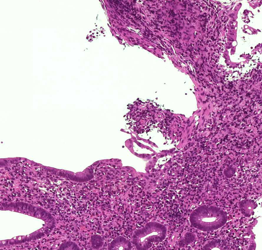 colitis ulcerosa felszíni hám sorvadt