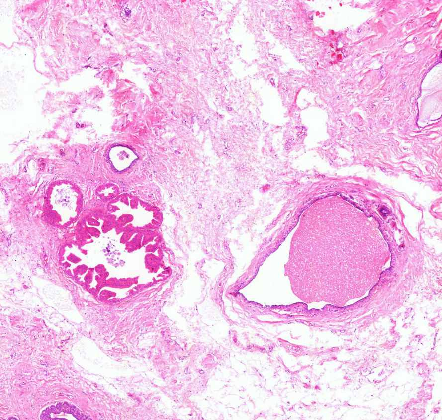 mastopathia fibrocystica apokrin metaplasia