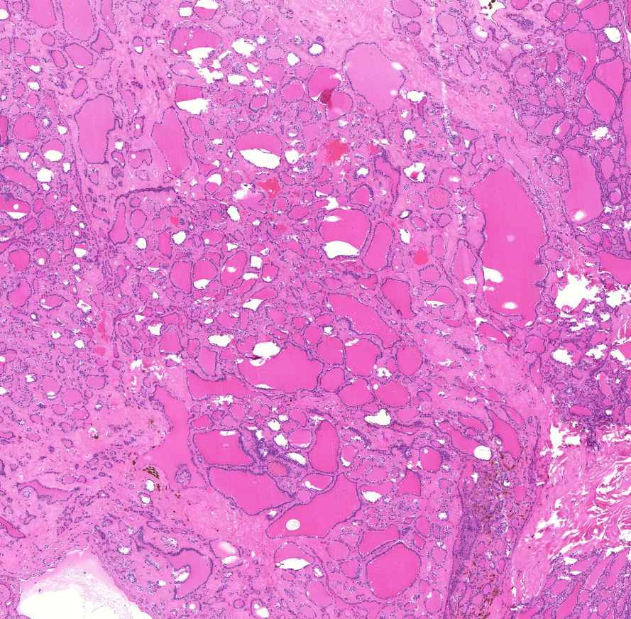 struma nodosa colloides 0