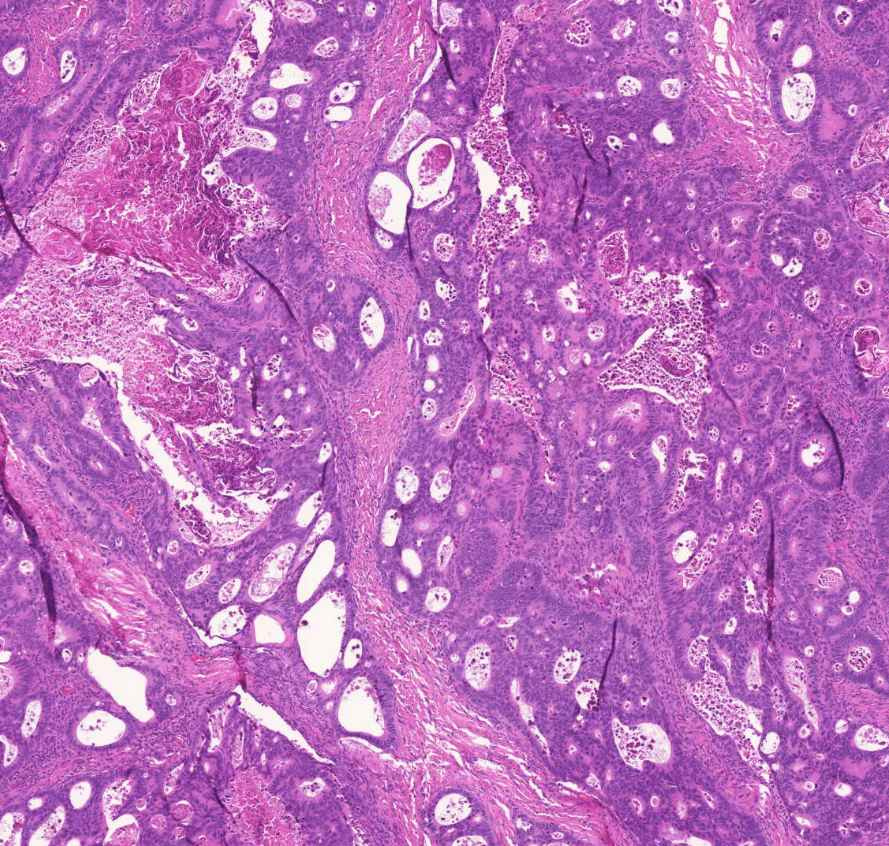 adenocarcinoma coli 0