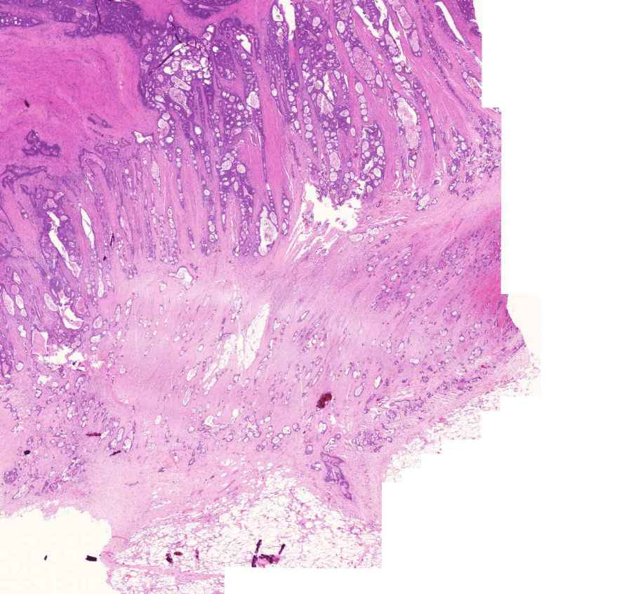 adenocarcinoma coli egészen a subserosus zsírszövetig