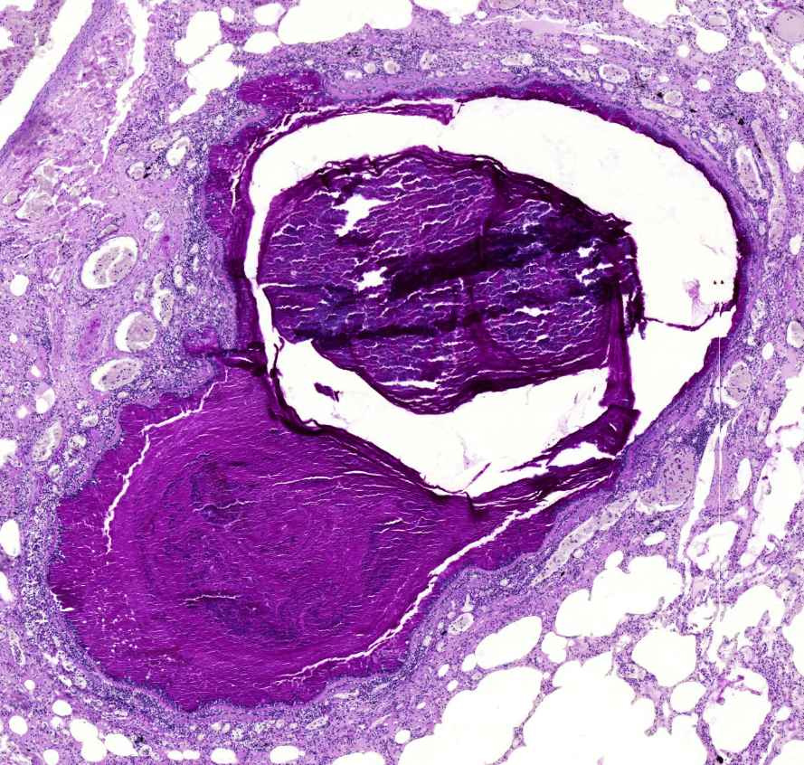 asthma bronchiale 0