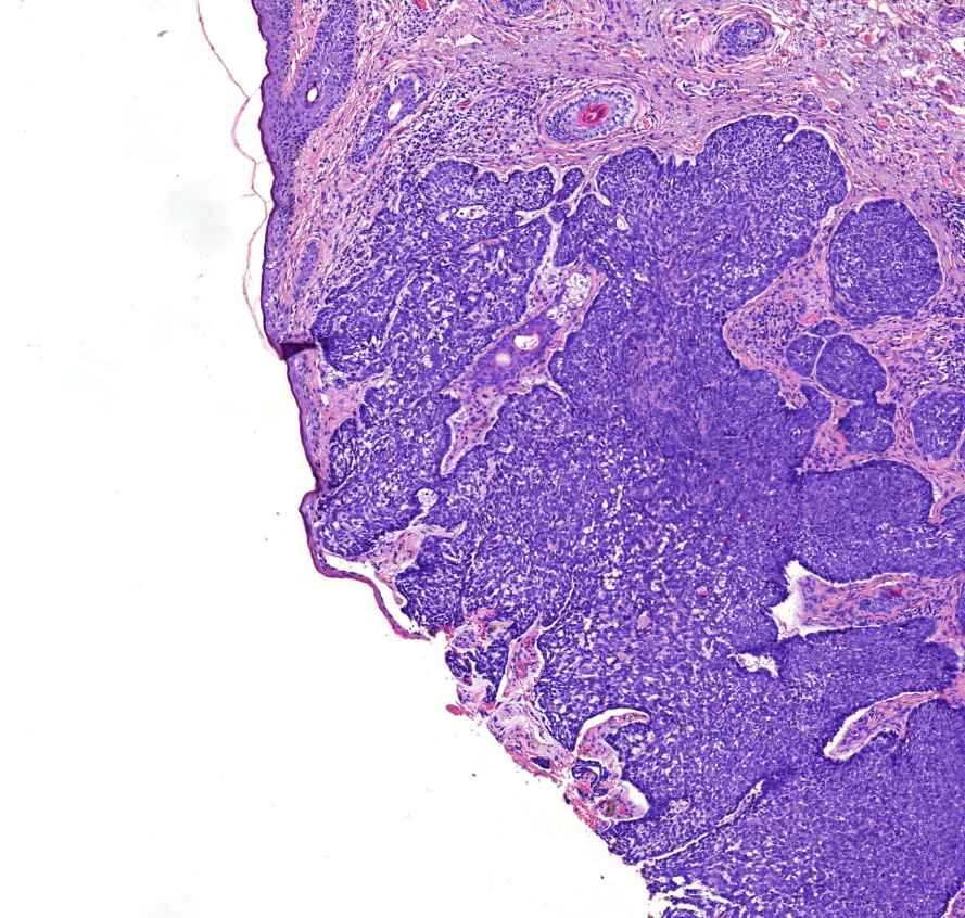 carcinoma basocellulare epidermis megszunik