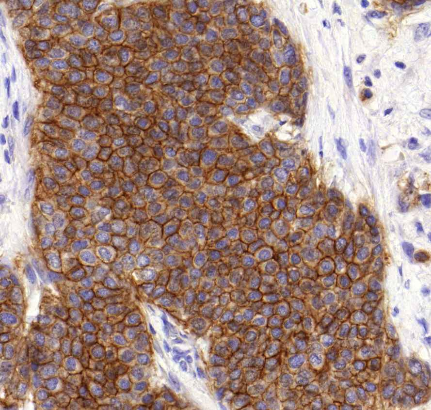 carcinoma ductale invasivum mammae (Her-2)