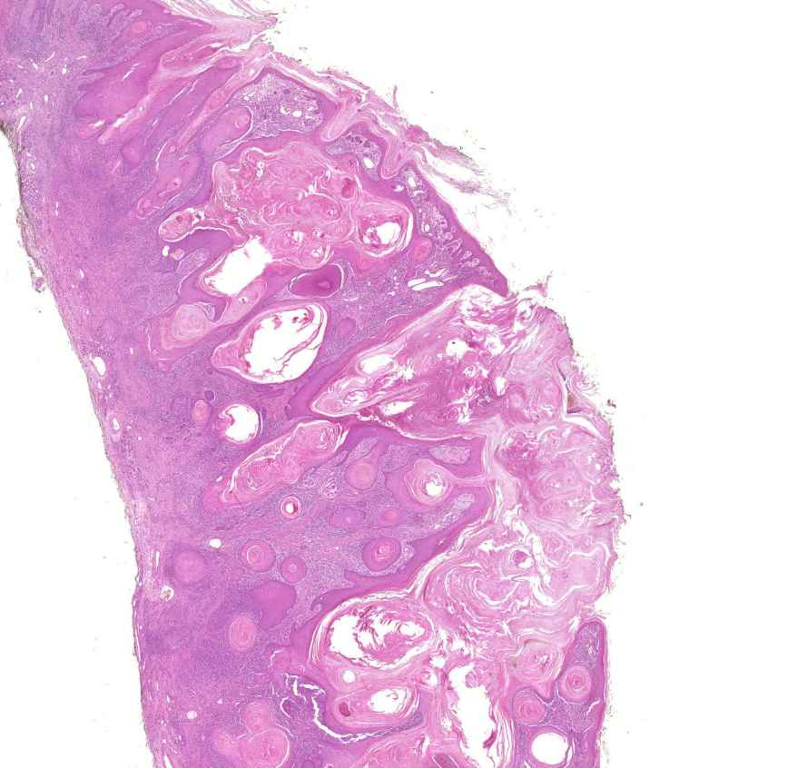 carcinoma planocellulare cutis 0