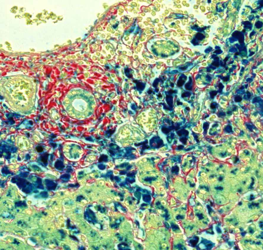 haemosiderosis hepatis (Berlini-kék)epeútban is megjelenik