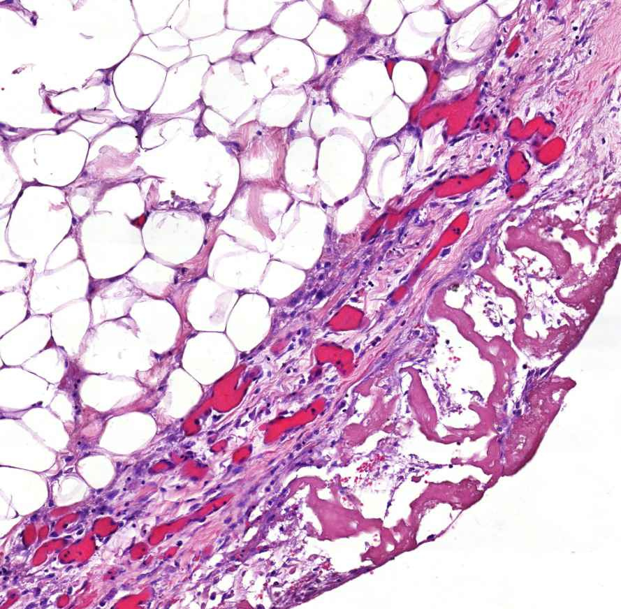 pericarditis fibrinosa0