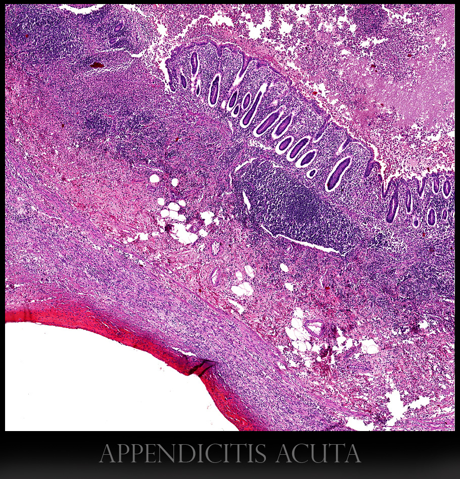 appendicitis acuta