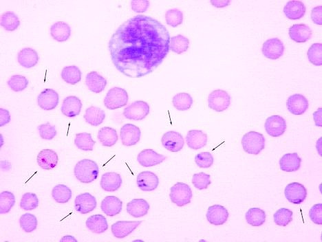 babesia divergens (Bo) zoonosis